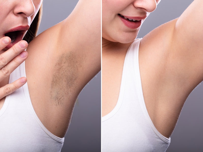 Before And After Concept Of Woman's Underarm Hair Removal On Grey Background